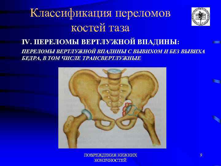 Классификация переломов костей таза IV. ПЕРЕЛОМЫ ВЕРТЛУЖНОЙ ВПАДИНЫ: ПЕРЕЛОМЫ ВЕРТЛУЖНОЙ ВПАДИНЫ С ВЫВИХОМ И