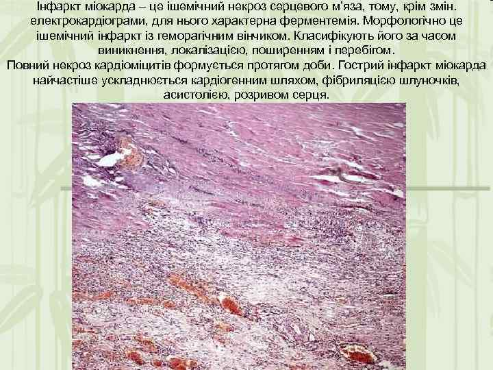 Інфаркт міокарда – це ішемічний некроз серцевого м’яза, тому, крім змін. електрокардіограми, для нього