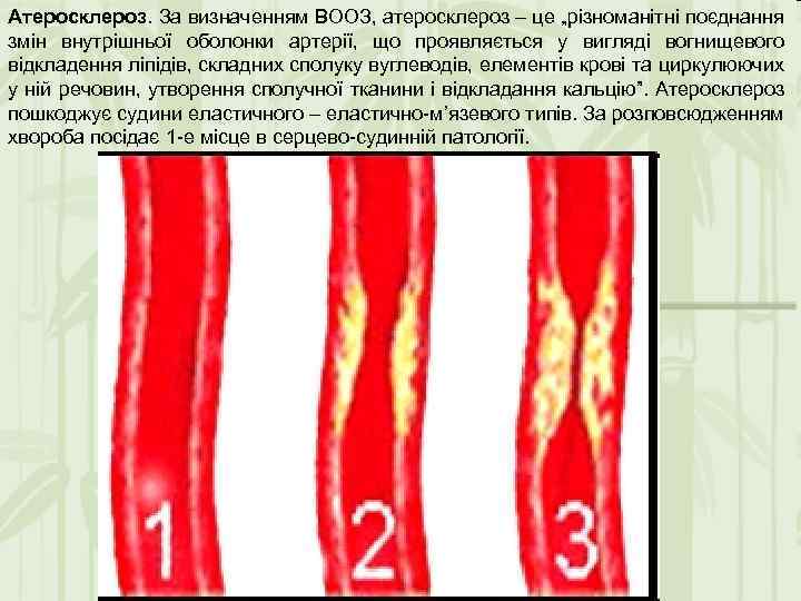 Атеросклероз. За визначенням ВООЗ, атеросклероз – це „різноманітні поєднання змін внутрішньої оболонки артерії, що