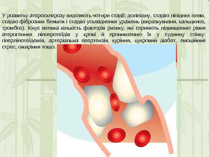 У розвитку атеросклерозу виділяють чотири стадії: доліпідну, стадію ліпідних плям, стадію фіброзних бляшок і