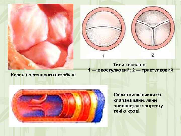 Клапан легеневого стовбура Типи клапанів: 1 — двостулковий; 2 — тристулковий Схема кишенькового клапана