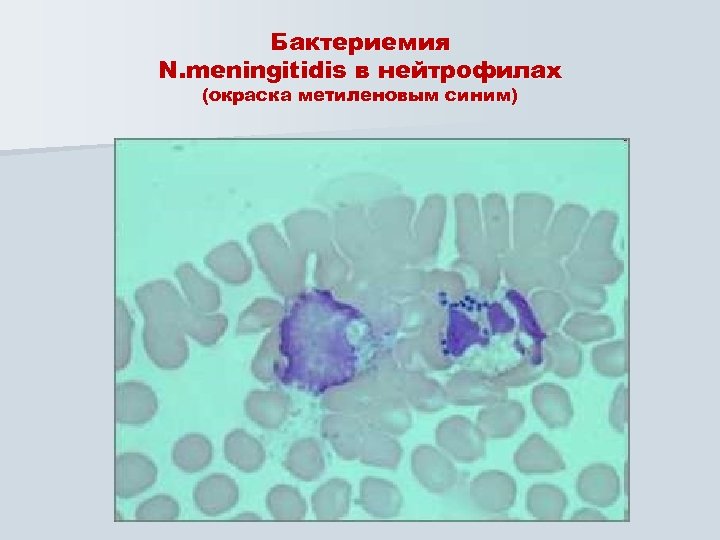 Бактериемия N. meningitidis в нейтрофилах (окраска метиленовым синим) 