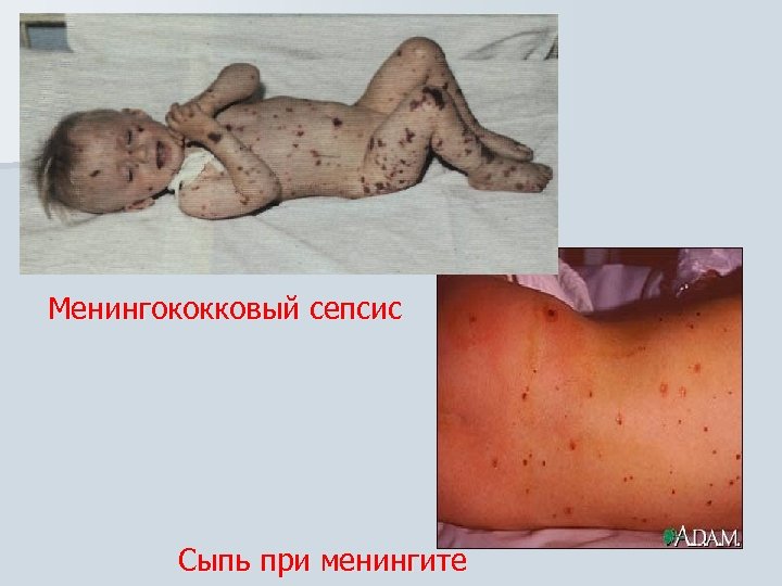 Менингококковый сепсис Сыпь при менингите 