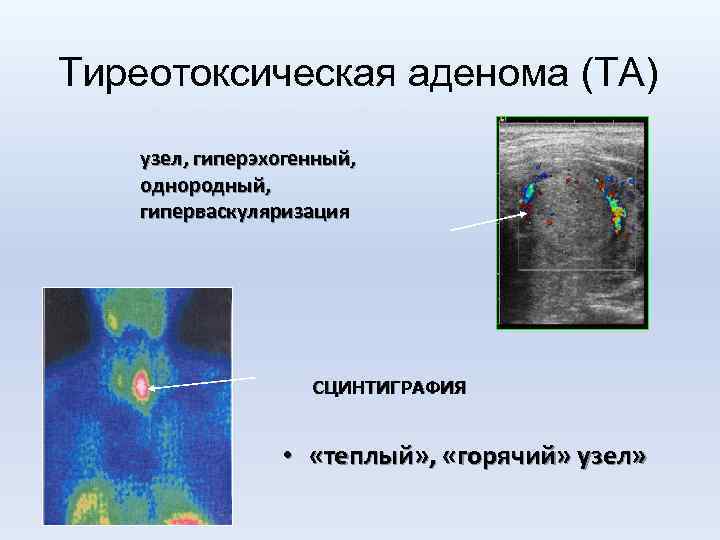 Тиреотоксическая аденома (ТА) УЛЬТРАЗВУКОВОЕ ИСЛЕДОВАНИЕ узел, гиперэхогенный, однородный, гиперваскуляризация СЦИНТИГРАФИЯ • «теплый» , «горячий»