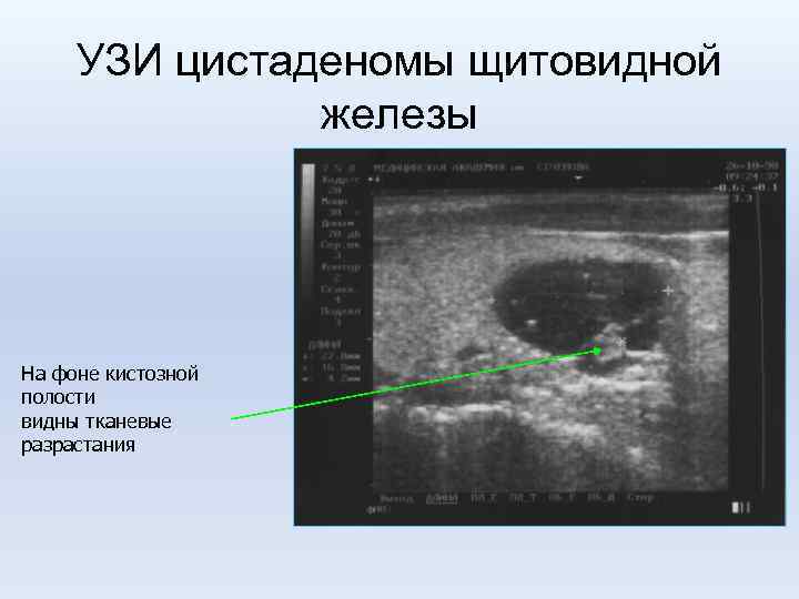 УЗИ цистаденомы щитовидной железы На фоне кистозной полости видны тканевые разрастания 