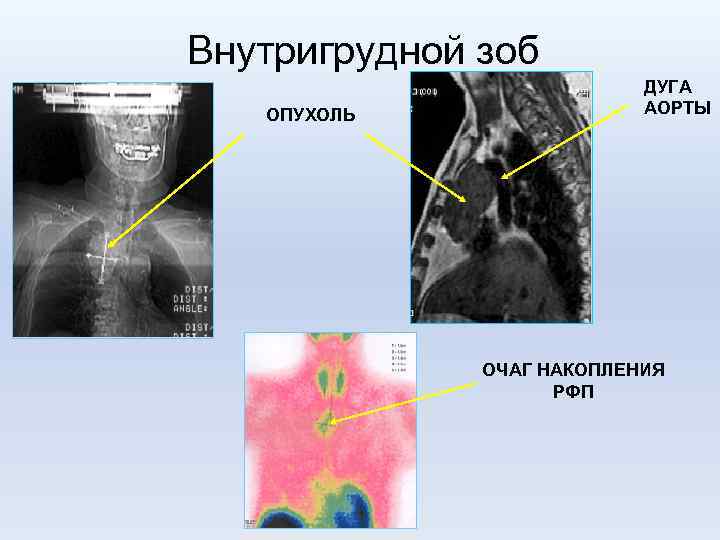 Внутригрудной зоб ОПУХОЛЬ ДУГА АОРТЫ ОЧАГ НАКОПЛЕНИЯ РФП 