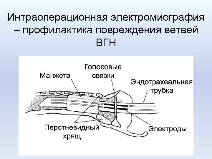 Интраоперационная электромиография – профилактика повреждения ветвей ВГН 