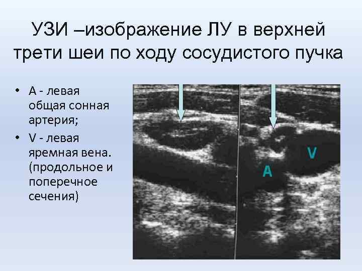 УЗИ –изображение ЛУ в верхней трети шеи по ходу сосудистого пучка • А -