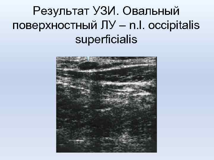 Результат УЗИ. Овальный поверхностный ЛУ – n. l. occipitalis superficialis 