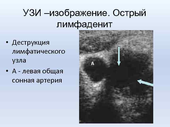 УЗИ –изображение. Острый лимфаденит • Деструкция лимфатического узла • А - левая общая сонная