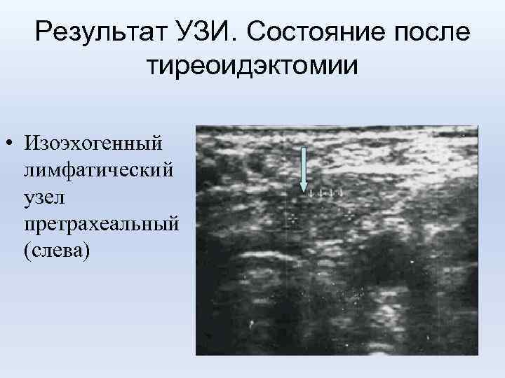 Результат УЗИ. Состояние после тиреоидэктомии • Изоэхогенный лимфатический узел претрахеальный (слева) 