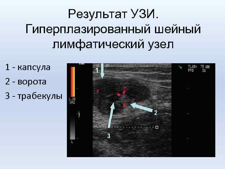 Узи периферических лимфоузлов