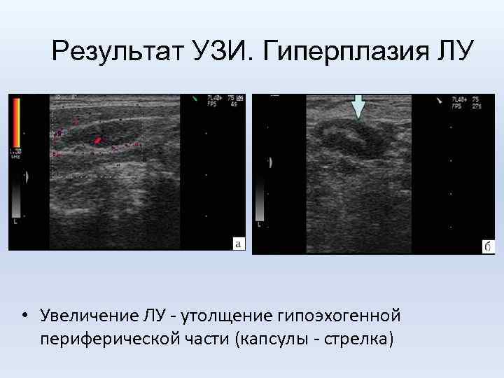 Результат УЗИ. Гиперплазия ЛУ • Увеличение ЛУ - утолщение гипоэхогенной периферической части (капсулы -