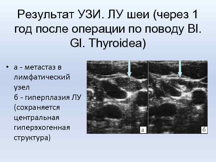 Результат УЗИ. ЛУ шеи (через 1 год после операции по поводу Bl. Gl. Thyroidea)