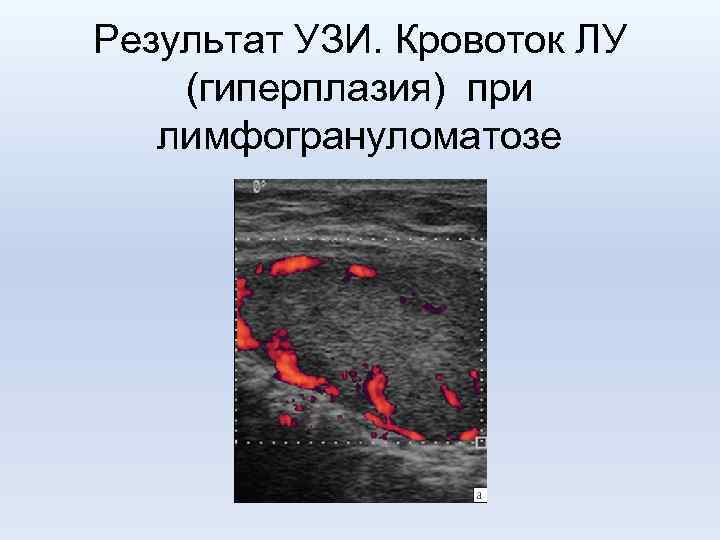 Результат УЗИ. Кровоток ЛУ (гиперплазия) при лимфогрануломатозе 