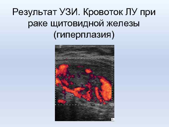 Результат УЗИ. Кровоток ЛУ при раке щитовидной железы (гиперплазия) 