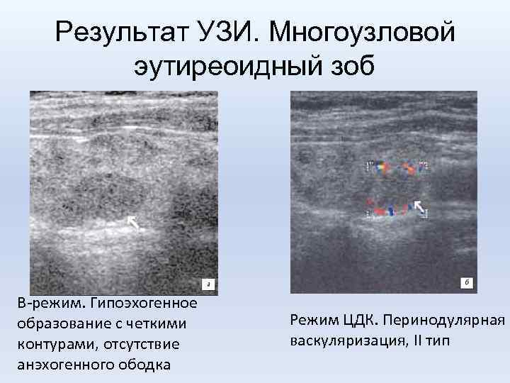 Результат УЗИ. Многоузловой эутиреоидный зоб В-режим. Гипоэхогенное образование с четкими контурами, отсутствие анэхогенного ободка