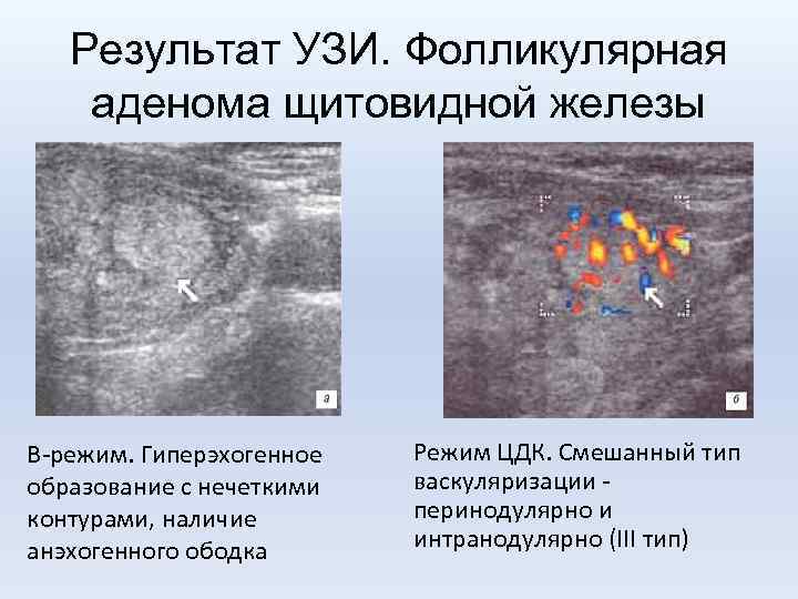 Результат УЗИ. Фолликулярная аденома щитовидной железы В-режим. Гиперэхогенное образование с нечеткими контурами, наличие анэхогенного