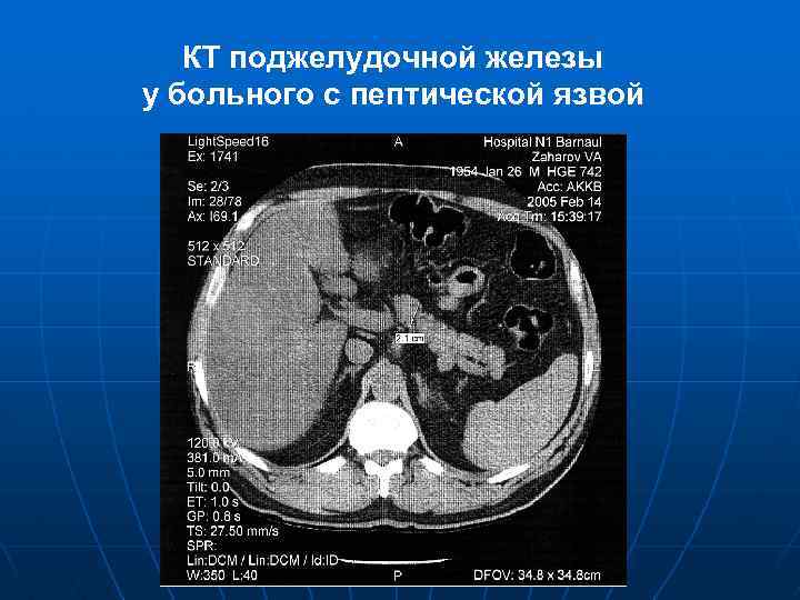 КТ поджелудочной железы у больного с пептической язвой 