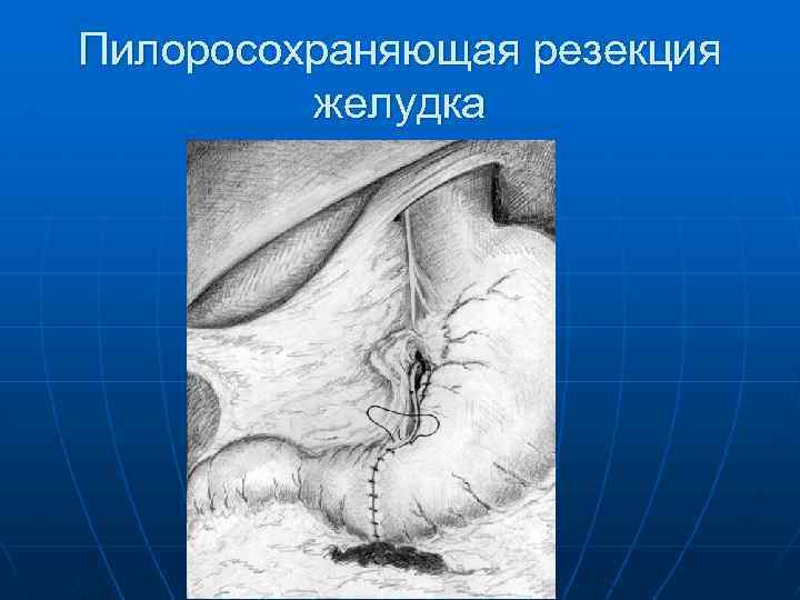 Пилоросохраняющая резекция желудка 