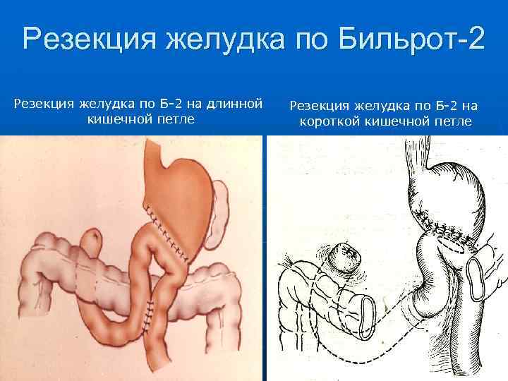 Результаты после резекции желудка фото