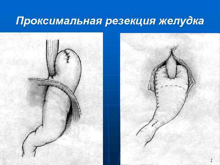 Результаты после резекции желудка фото