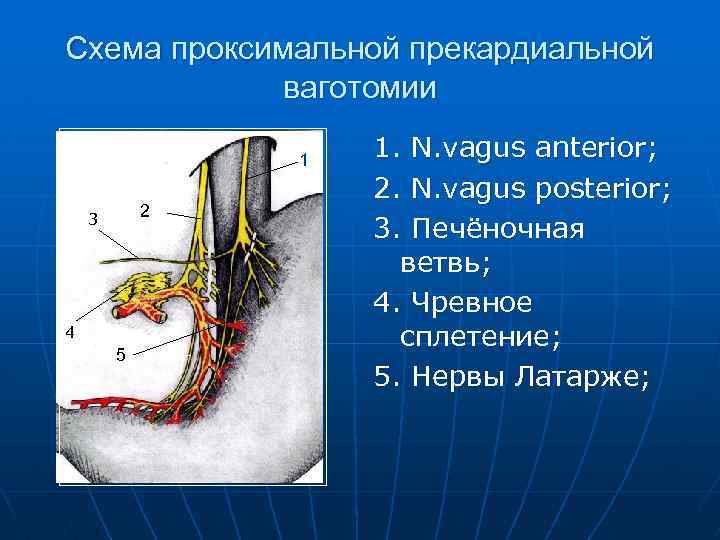 Схема проксимальной прекардиальной ваготомии 1 3 3 44 4 5 2 1. N. vagus