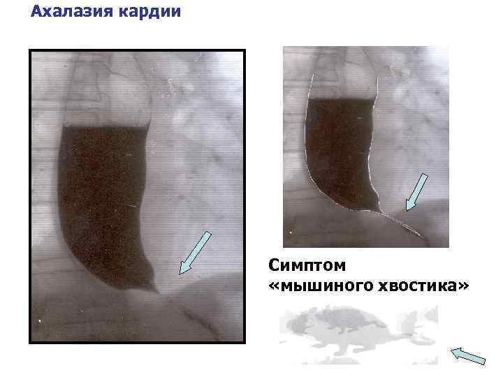 Ахалазия кардии Симптом «мышиного хвостика» 