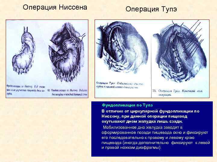 Операция Ниссена Операция Тупэ Фундопликация по Тупэ В отличие от циркулярной фундопликации по Ниссену,