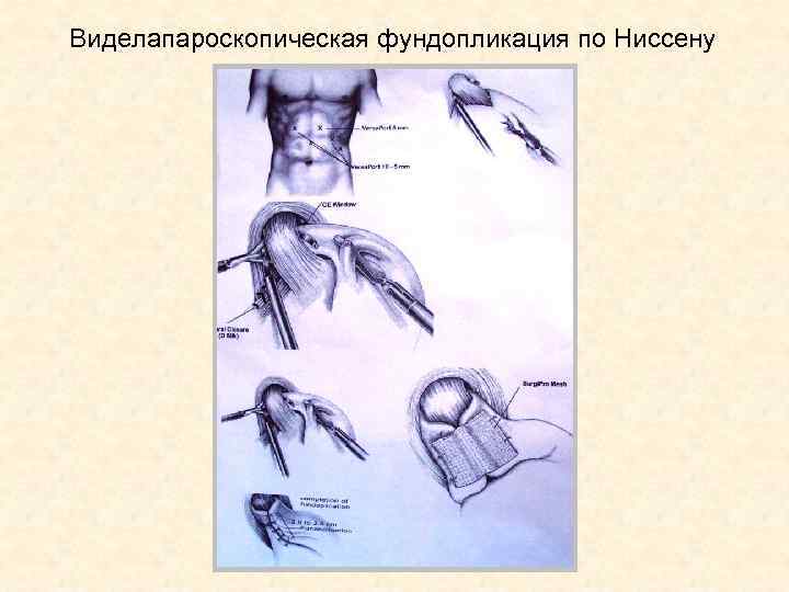 Виделапароскопическая фундопликация по Ниссену 