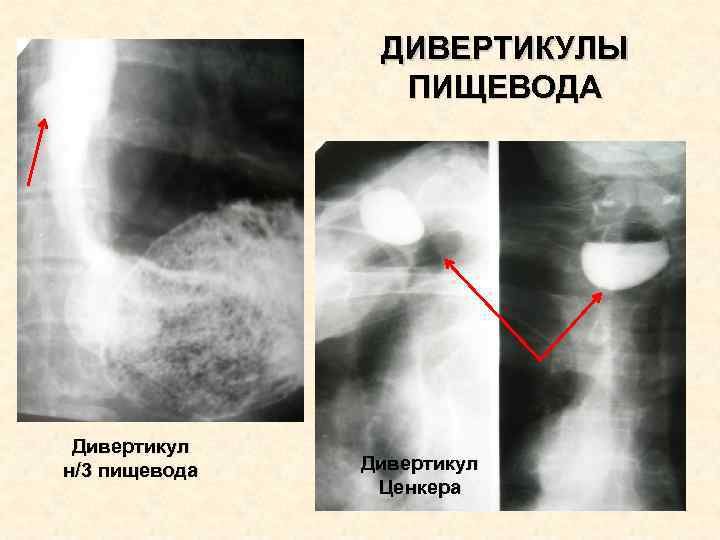 ДИВЕРТИКУЛЫ ПИЩЕВОДА Дивертикул н/3 пищевода Дивертикул Ценкера 