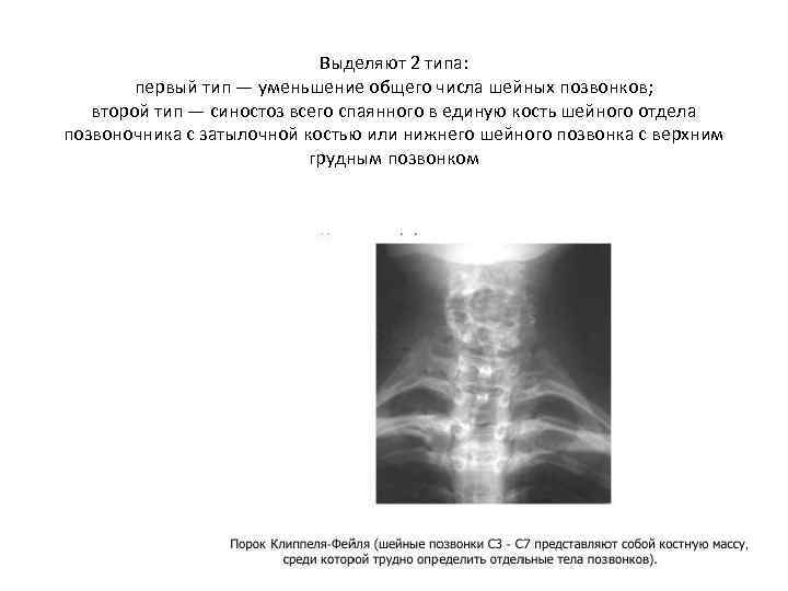 Выделяют 2 типа: первый тип — уменьшение общего числа шейных позвонков; второй тип —