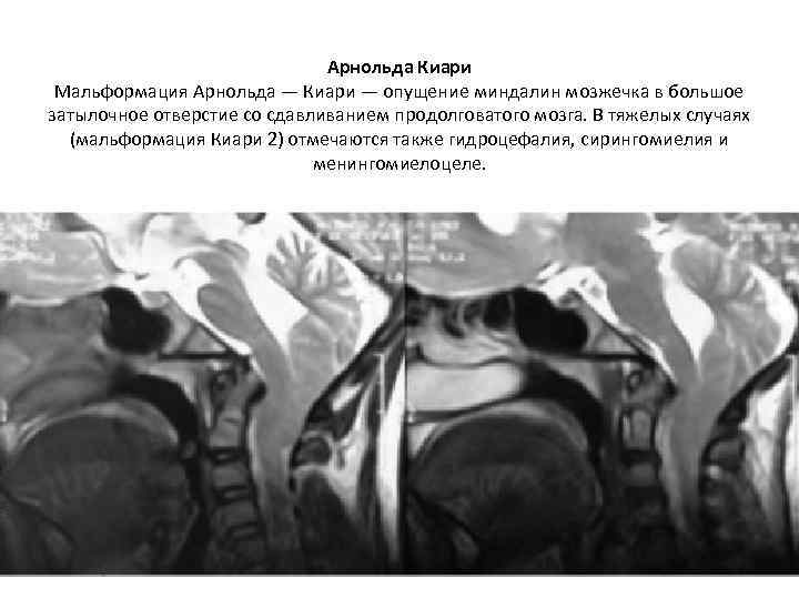 Арнольда Киари Мальформация Арнольда — Киари — опущение миндалин мозжечка в большое затылочное отверстие