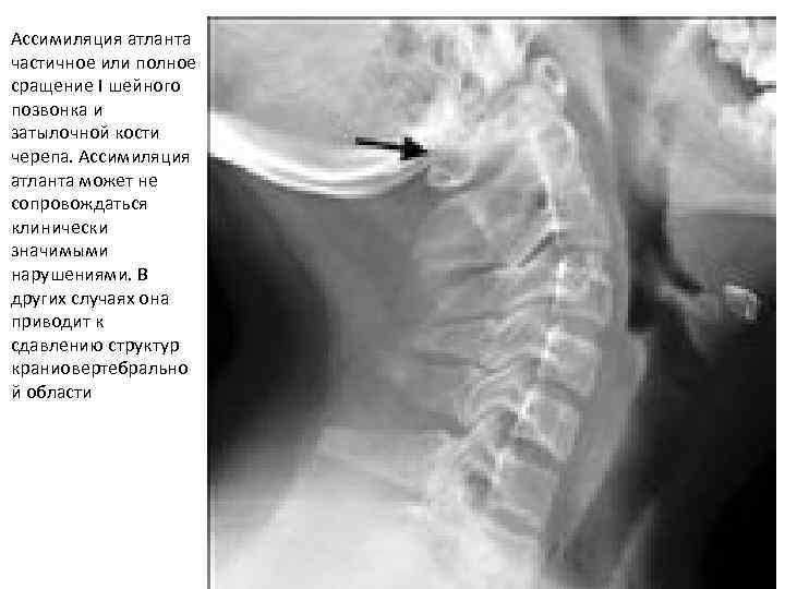 Ассимиляция атланта частичное или полное сращение I шейного позвонка и затылочной кости черепа. Ассимиляция