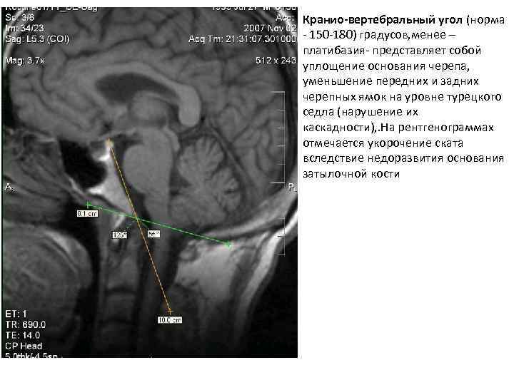 Кранио-вертебральный угол (норма - 150 -180) градусов, менее – платибазия- представляет собой уплощение основания