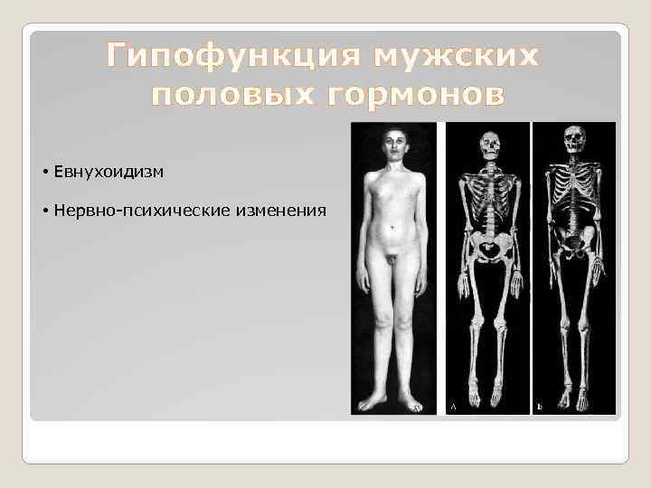Гипофункция мужских половых гормонов • Евнухоидизм • Нервно-психические изменения 