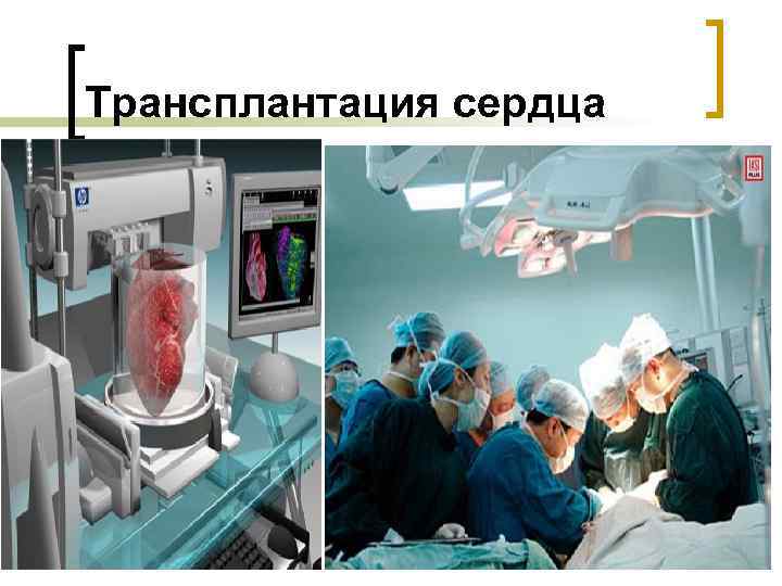 Трансплантация сердца 