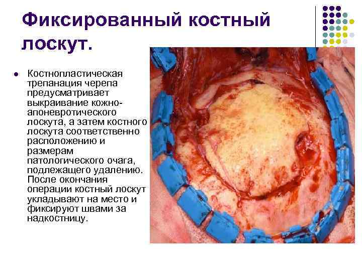 Фиксированный костный лоскут. l Костнопластическая трепанация черепа предусматривает выкраивание кожноапоневротического лоскута, а затем костного