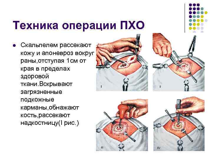 Хирургическая обработка ран