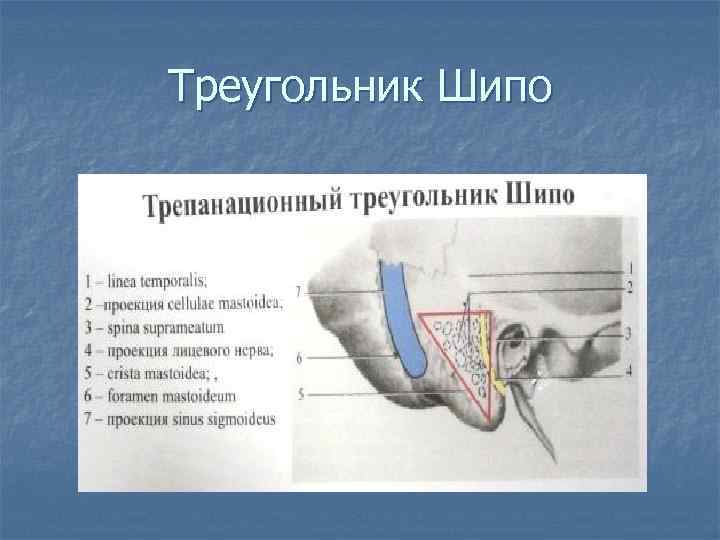 Трепанационный треугольник шипо схема