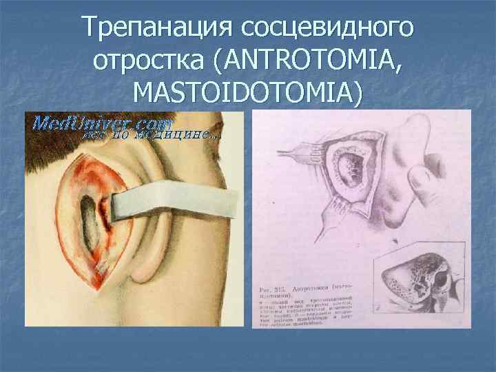 Трепанация сосцевидного отростка (ANTROTOMIA, MASTOIDOTOMIA) 