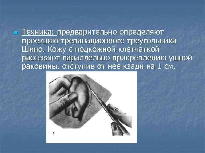 n Техника: предварительно определяют проекцию трепанационного треугольника Шипо. Кожу с подкожной клетчаткой рассекают параллельно