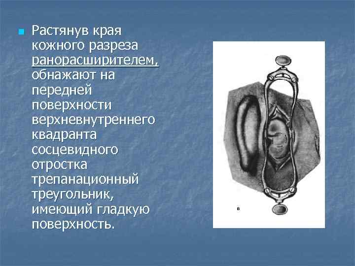 n Растянув края кожного разреза ранорасширителем, обнажают на передней поверхности верхневнутреннего квадранта сосцевидного отростка