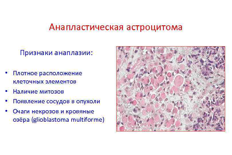 Анапластическая астроцитома Признаки анаплазии: • Плотное расположение клеточных элементов • Наличие митозов • Появление