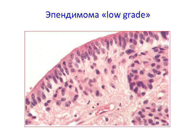 Эпендимома «low grade» 