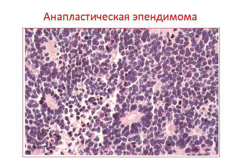 Анапластическая эпендимома 