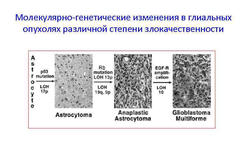 Молекулярно-генетические изменения в глиальных опухолях различной степени злокачественности 