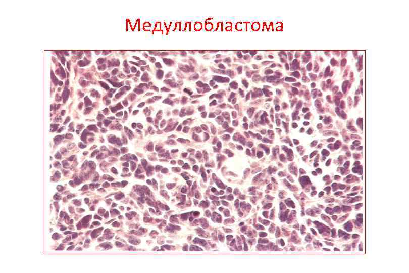 Медуллобластома 