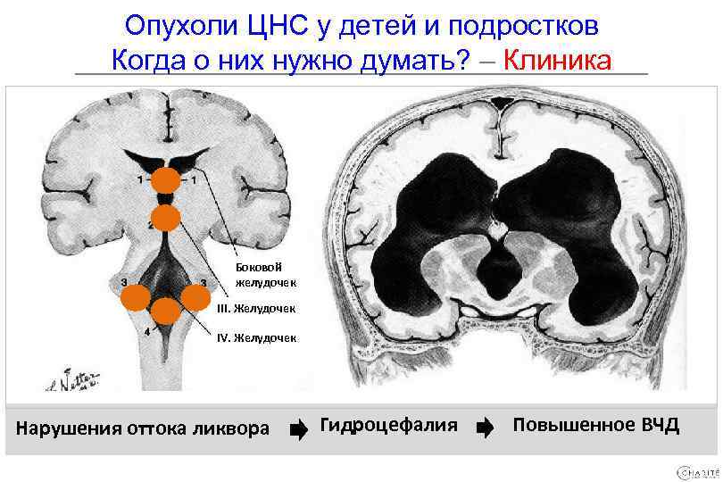 Опухоли ЦНС у детей и подростков Когда о них нужно думать? – Клиника Боковой
