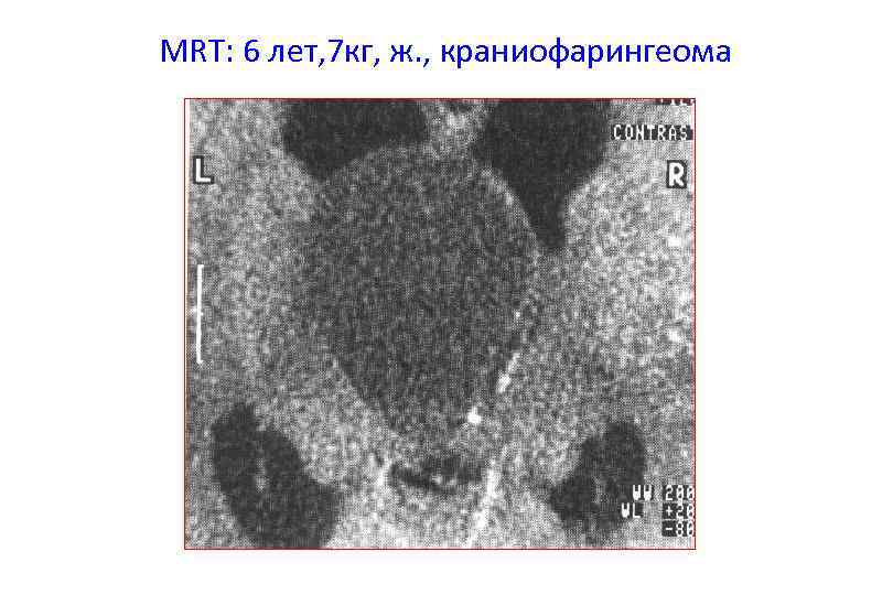 MRT: 6 лет, 7 кг, ж. , краниофарингеома 